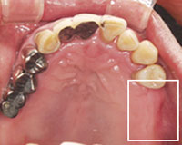 治療前の上の歯