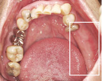 治療前の下の歯