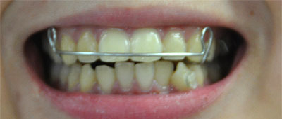 歯を動かすと言えば「矯正歯科」「矯正治療」