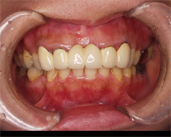 他医院で自由診療でセラミックの治療を行っている 上の前歯6本