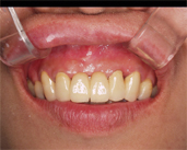 吉本歯科医院でのセラミックの治療をやりかえた完成写真 上の前歯6本